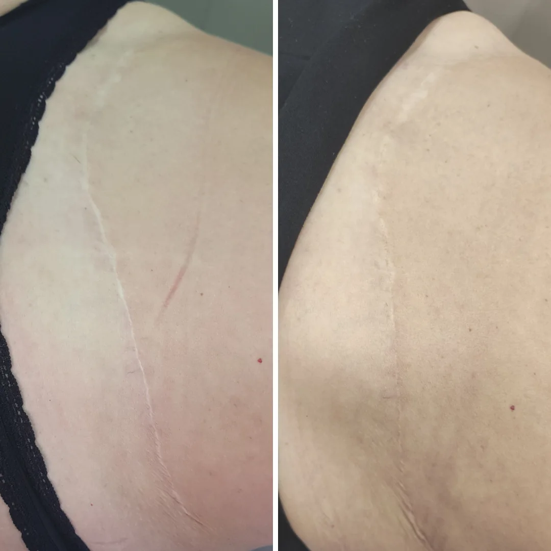 Comparativo real de cicatriz antes e depois